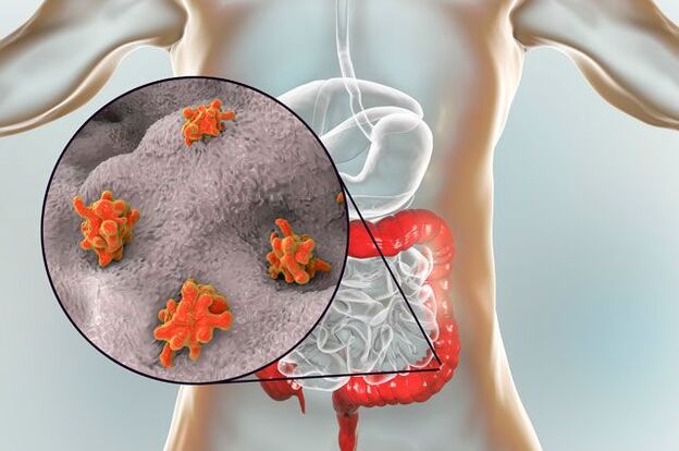 Arten von Parasiten im menschlichen Körper