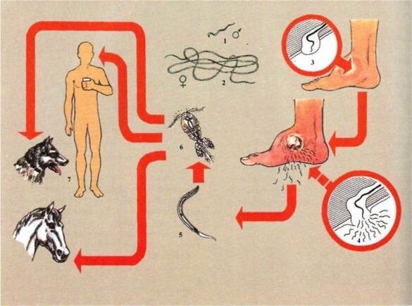 Entwicklung einer Dracunculiasis.